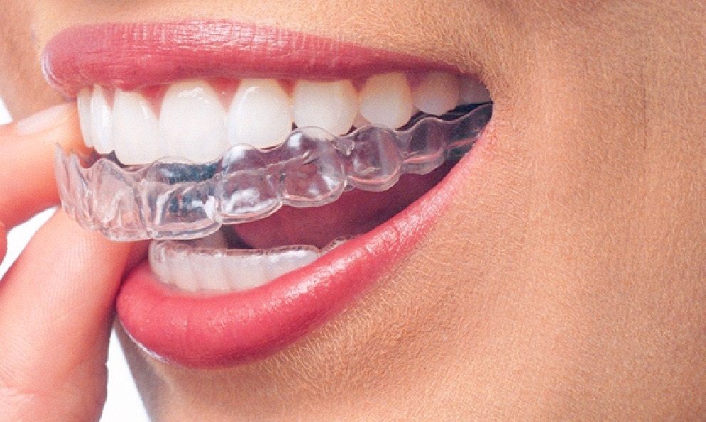 Restore The Arrogance, Get Teeth Implants Dubai Treatment