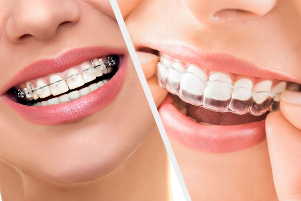 What Are the Benefits of Invisalign Over Traditional Braces?