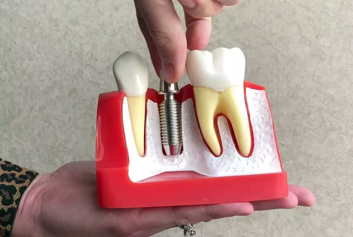 Different Types of Dental Implants – Endosteal Vs. Subperiosteal Implants 